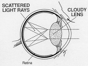 Optelec, Low Vision, Customer Service, Customer Service, Customer Service, Glaucoma, Diabetic Retinopathy, Low Vision Aids, Visually Impaired